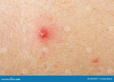 Carbuncle And Folliculitis With Surrounding Cellulitis Or