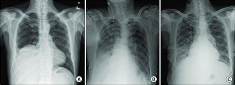 A Preoperative Chest Radiography Showing Right Costophrenic Angle