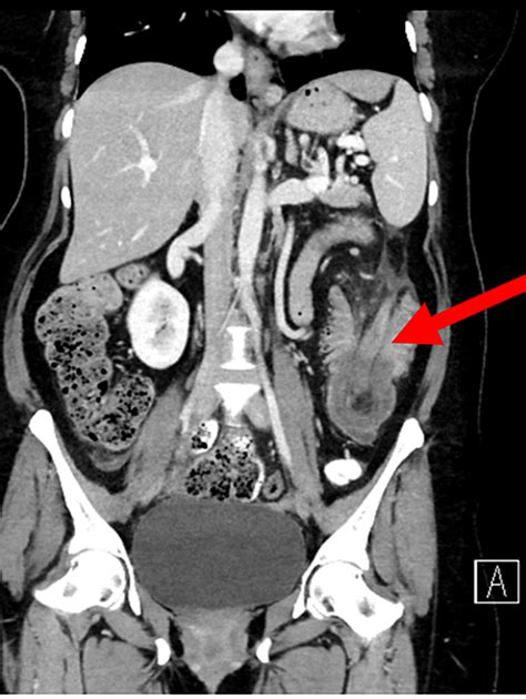 Cureus Colonic Lipoma As A Leading Cause Of Intussusception Resulting In Bowel Obstruction