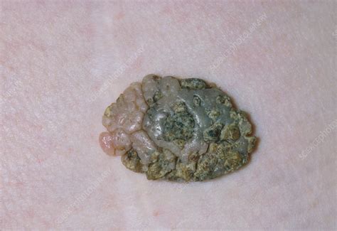 Close Up Of A Seborrhoeic Keratosis Or Wart Stock Image M