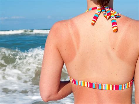 Here S What S Actually Happening To Your Body When You Get A Sunburn