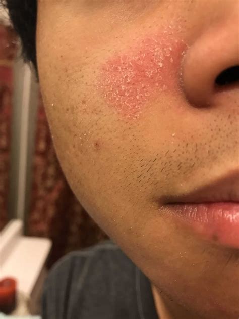 Skin Concern Ive Had This Red Flaky Spot On My Face For Over A Year