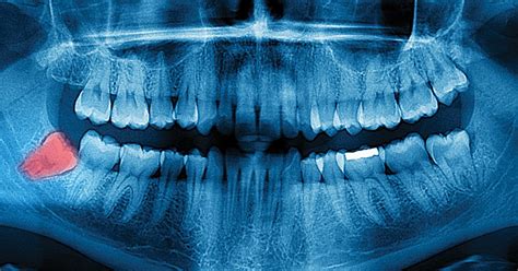 Are Wisdom Teeth Evidence For Evolution Answers In Genesis