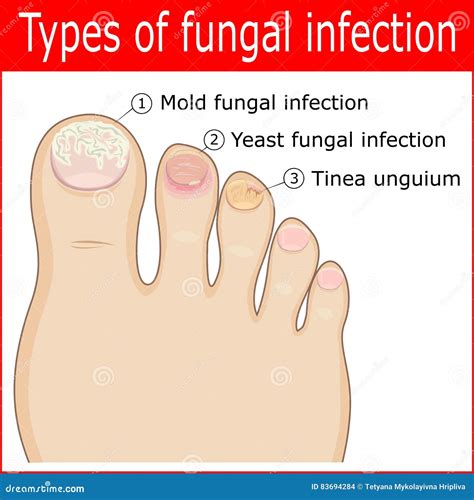 Types Of Fungal Infections Stock Vector Illustration Of Fungal 83694284