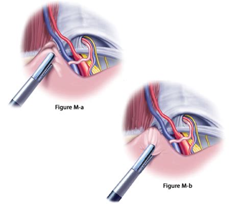 About Laparoscopic Hernia Surgery California Hernia Specialists