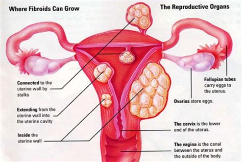 Do you know what a smear test actually does? Uterine Fibroids - Non Surgical Fibroid Treatment