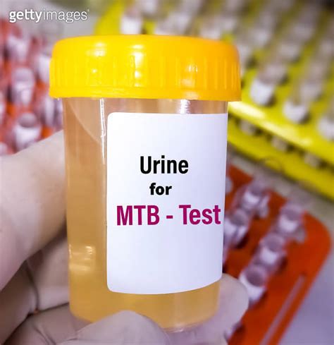 Urine Sample For Genexpert Mtb Test In Pcr Laboratory To Diagnoses