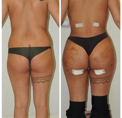 Countries To Get Affordable Brazilian Butt Lift Compare Prices