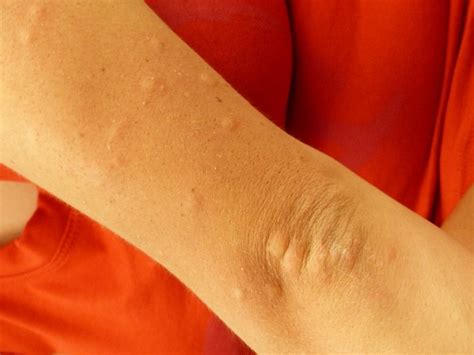 Itchy Arm Current Health Advice Health Blog Articles And Tips