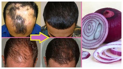 Onion For Hair Regrowth Fast Hair Growth With Onion Paste Diy