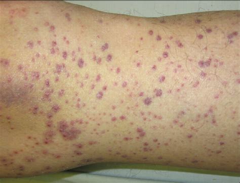 Scurvy Causes Symptoms Scurvy Skin Rash Diagnosis And Scurvy Treatment