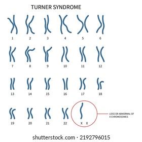 Vektor Stok Turner Fragile Syndrome X Chromosomal Abnormality Tanpa