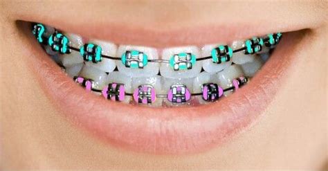 Braces Types — Newark Orthodontic Center