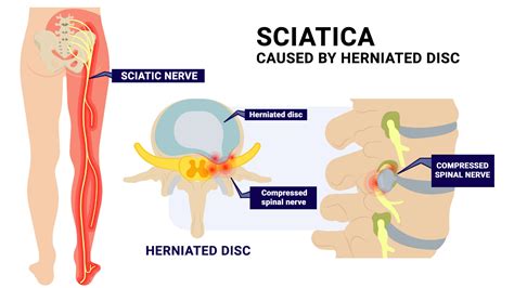 Physical Therapy For Sciatica Pain Physical Therapists Nyc