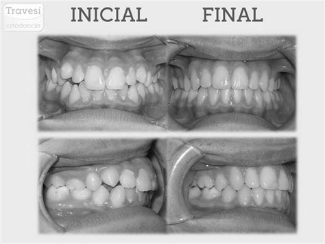 Gestión de resultados e informes vía web. Primeros resultados con Invisalign ¿Cuándo se empiezan a ...