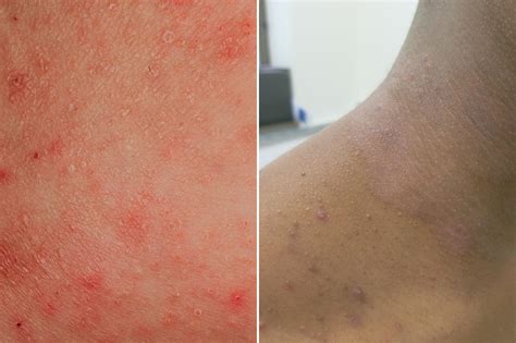 Rosacea Vs Psoriasis Vs Eczema Whats The Difference The Healthy