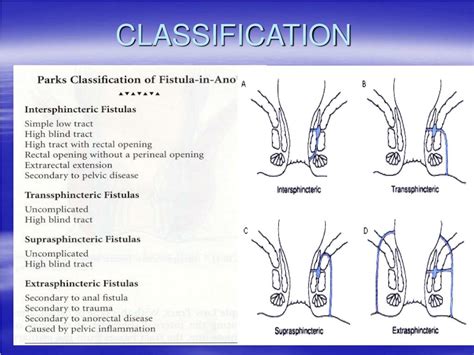 Ppt Anorectal Abscesses And Fistula In Ano Powerpoint Hot Sex The