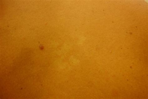 Derm Dx Hypopigmented Macules On A Womans Back Clinical Advisor