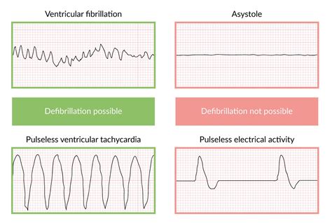 pulseless electrical activity vs asystole