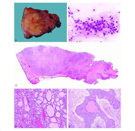 Gross Cytologic And Histologic Pathology The Cut Surface Of The