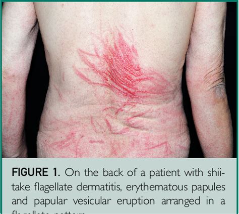 Figure 1 From Shiitake Flagellate Dermatitis Semantic Scholar