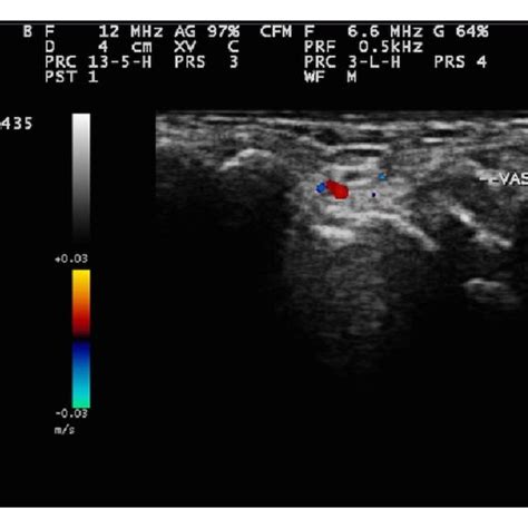 Sternoclavicular Joint Ultrasound