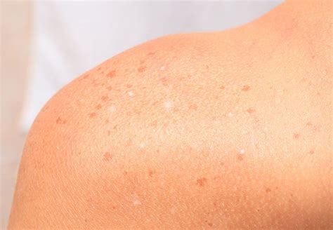 Sun Spots On Skin Itchy Rash Skin Rash Eczema Causes Fungal Infection Skin Antifungal