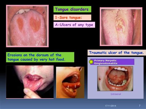 Ppt Tougue Disorders Powerpoint Presentation Free Download Id6719147