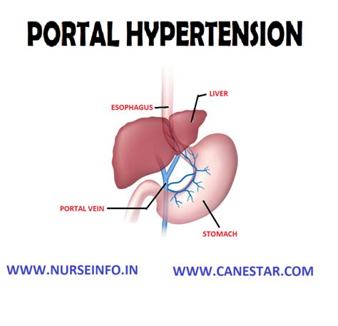Portal Hypertension Nurse Info
