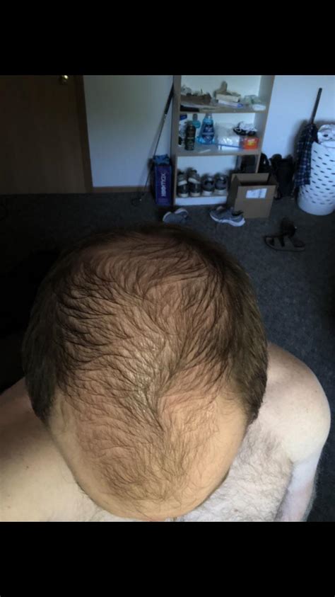 Retrograde Alopecia On Side Of Head Only 21 Hairloss