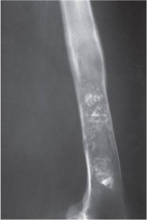 Musculoskeletal Oncology - Current Diagnosis & Treatment ...