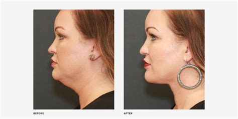 4 Things To Look For In Neck Lift Before And After Photos Realself News