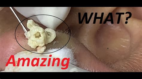 26 Big Cyst On The Ears Blackheads And Whiteheads For Uncle Youtube
