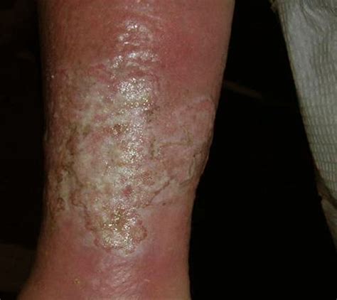 Venous Stasis Ulcer Pictures Symptoms Causes Treatment