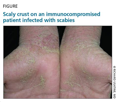 Scabies Refine Your Exam Avoid These Diagnostic Pitfalls Mdedge