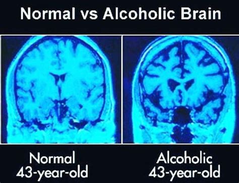 Normal Vs Alcoholic Brain Stop The Use Of Alcohol Medizzy