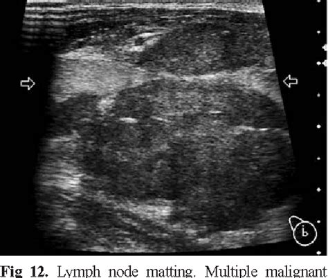 Figure 12 From Ultrasonography Of Superficial Lymph Nodes Benign Vs