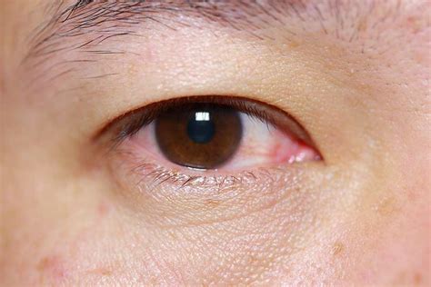 Pink Eye & Eye Infections | Symptoms