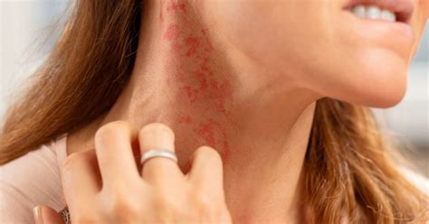 Miliaria is a sign that the body is having a negative response to heat. 8 types of itchy rash