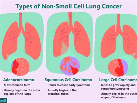 Small Cell Carcinoma Early Lung Cancer Xray Small Cell Lung Carcinoma