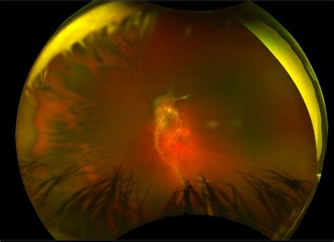 NVD With Traction And Vitreous Hemorrhage Retina Image Bank