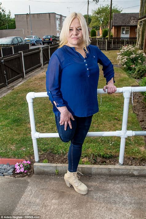 Breaston Woman Needed Her Leg Amputated After A Cut While