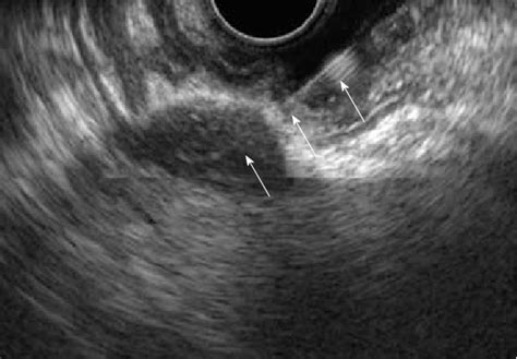 Endoscopic Ultrasonography Guided Fine Needle Aspiration Of A 20 Mm