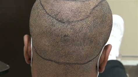 African American Fue Donor Scar Demonstration Post Hair Transplant