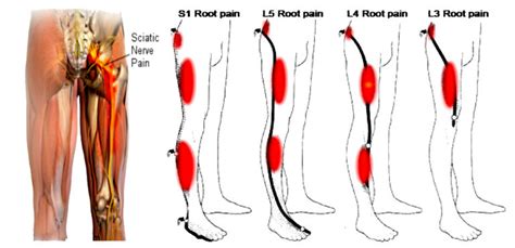 Chiropractic Treatment Of Sciatica Or Leg Pain Accent On Health Chiropractic