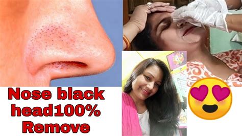 remove black heads  nose youtube