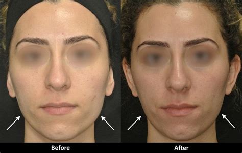 Slim Your Face With Botox
