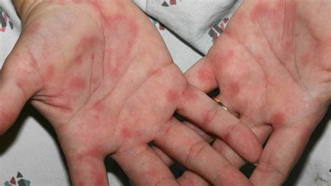 Itchy Blister Rash On Hands And Feet Rashes In Children Learning