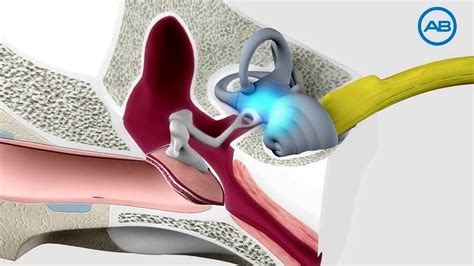 How A Cochlear Implant Works By Advanced Bionics Youtube