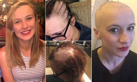 Srudents Horror As Alopecia Caused Her Golden Locks To Fall Out In